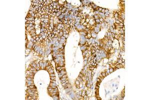 Immunohistochemistry of paraffin-embedded Human colon carcinoma using CD147/BSG antibody (ABIN7265838) at dilution of 1:100 (40x lens). (CD147 anticorps)
