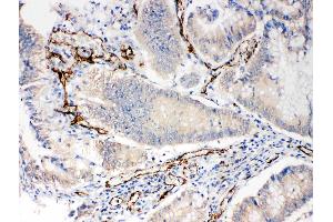 Anti-CD31 antibody, IHC(P): Human Intestinal Cancer Tissue (CD31 anticorps  (C-Term))