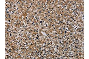 The image on the left is immunohistochemistry of paraffin-embedded Human prostate cancer tissue using ABIN7191019(HSPG2 Antibody) at dilution 1/50, on the right is treated with synthetic peptide. (HSPG2 anticorps)