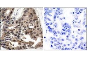 Immunohistochemistry analysis of paraffin-embedded human breast carcinoma tissue, using 4E-BP1 (Ab-36) Antibody. (eIF4EBP1 anticorps  (AA 4-53))