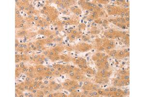Immunohistochemistry of paraffin-embedded human liver cancer tissue, using GNA11 antibody. (GNA11 anticorps)