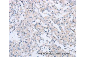 Immunohistochemistry of Human thyroid cancer using AGAP2 Polyclonal Antibody at dilution of 1:60 (AGAP2 anticorps)