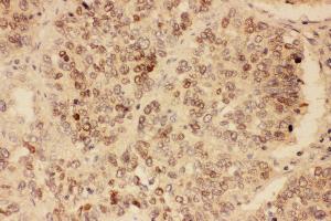 Anti-SOX2 antibody, IHC(P) IHC(P): Human Lung Cancer Tissue