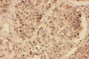 Anti-SOX2 antibody, IHC(P) IHC(P): Human Lung Cancer Tissue (SOX2 anticorps  (Middle Region))