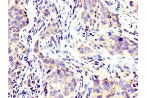 IHC image of ABIN7174344 diluted at 1:200 and staining in paraffin-embedded human pancreatic cancer performed on a Leica BondTM system.