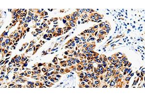 Immunohistochemistry of paraffin-embedded Human lung cancer tissue using COX16 Polyclonal Antibody at dilution 1:50 (COX16 anticorps)