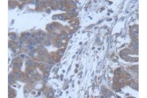 Detection of POFUT1 in Human Liver cancer Tissue using Polyclonal Antibody to Protein O-Fucosyltransferase 1 (POFUT1) (POFUT1 anticorps  (AA 238-388))