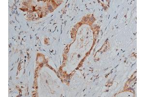 ABIN6267287 at 1/50 staining human lung cancer tissue sections by IHC-P.