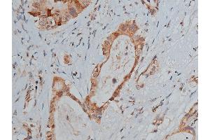 ABIN6267287 at 1/50 staining human lung cancer tissue sections by IHC-P. (p53 anticorps  (pSer20))