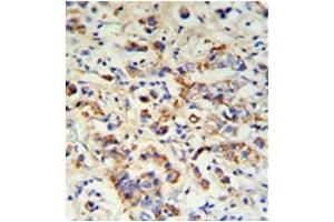 Formalin fixed, paraffin embedded breast carcinoma stained with DCT Antibody (N-term) followed by peroxidase conjugation of the secondary antibody and DAB staining. (DCT anticorps  (N-Term))