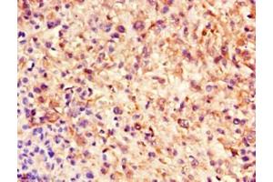 Immunohistochemistry of paraffin-embedded human melanoma using ABIN7161178 at dilution of 1:100