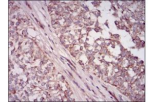 Immunohistochemical analysis of paraffin-embedded bladder cancer tissues using NT5E mouse mAb with DAB staining.