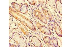Immunohistochemistry of paraffin-embedded human gastric cancer using ABIN7169664 at dilution of 1:100