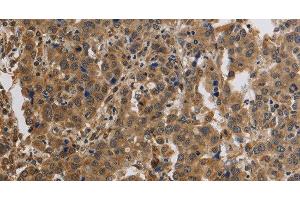 Immunohistochemistry of paraffin-embedded Human liver cancer using KCNMB4 Polyclonal Antibody at dilution of 1:40 (KCNMB4 anticorps)