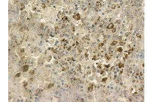ABIN6258777 and ABIN6273394 at 1/100 staining human melanoma by IHC-P. (CCL24 anticorps  (C-Term))