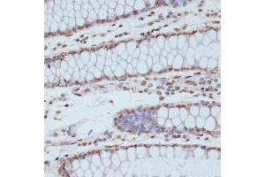 Immunohistochemistry of paraffin-embedded human colon using Phospho-CDK1-Y15 antibody (ABIN3019442, ABIN3019443, ABIN3019444 and ABIN6225371) at dilution of 1:100 (40x lens). (CDK1 anticorps  (pTyr15))