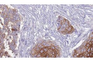 ABIN6277266 at 1/100 staining Human urothelial cancer tissue by IHC-P. (FCGR3A anticorps  (C-Term))
