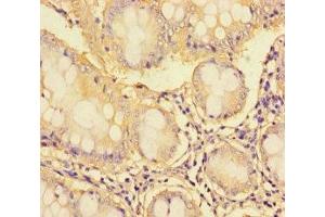 Immunohistochemistry of paraffin-embedded human colon cancer using ABIN7171095 at dilution of 1:100 (SYN1 anticorps  (AA 113-420))