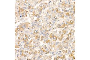 Immunohistochemistry of paraffin-embedded human liver cancer using /AMID Rabbit pAb (ABIN6129888, ABIN6136678, ABIN6136679 and ABIN6215707) at dilution of 1:25 (40x lens). (AIFM2 anticorps  (AA 1-373))