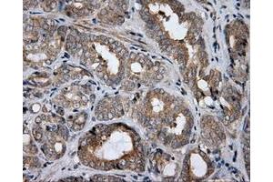 Immunohistochemical staining of paraffin-embedded Adenocarcinoma of colon tissue using anti-HDAC10 mouse monoclonal antibody. (HDAC10 anticorps)