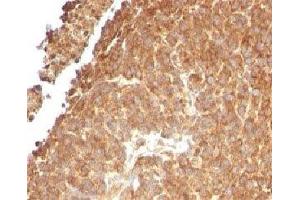 IHC testing of FFPE human melanoma with TOP1MT antibody (clone TPIMT-1). (TOP1MT anticorps)