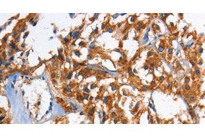 Immunohistochemistry of paraffin-embedded Human thyroid cancer using HK2 Polyclonal Antibody at dilution of 1:60 (Hexokinase 2 anticorps)