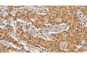 Immunohistochemistry of paraffin-embedded Human gastic cancer using ARHGAP25 Polyclonal Antibody at dilution of 1:40