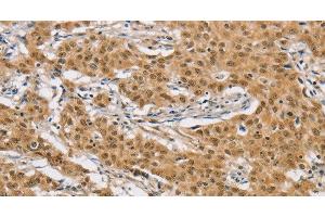 Immunohistochemistry of paraffin-embedded Human gastic cancer using ARHGAP25 Polyclonal Antibody at dilution of 1:40 (ARHGAP25 anticorps)