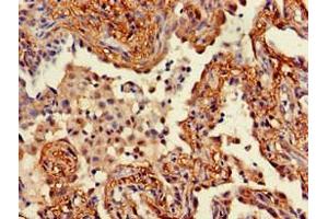 Immunohistochemistry of paraffin-embedded human lung cancer using ABIN7166304 at dilution of 1:100