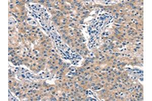 The image on the left is immunohistochemistry of paraffin-embedded Human gastric cancer tissue using ABIN7190538(EID3 Antibody) at dilution 1/15, on the right is treated with synthetic peptide. (EID3 anticorps)