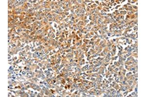 The image on the left is immunohistochemistry of paraffin-embedded Human ovarian cancer tissue using ABIN7191349(MAGEB2 Antibody) at dilution 1/40, on the right is treated with synthetic peptide. (MAGEB2 anticorps)
