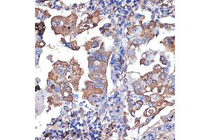 Immunohistochemistry of paraffin-embedded human lung cancer using VPS11 Rabbit mAb (ABIN7271272) at dilution of 1:100 (40x lens). (VPS11 anticorps)