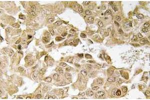 Immunohistochemistry (IHC) analyzes of MEK1 antibody in paraffin-embedded human breast carcinoma tissue. (MEK1 anticorps)