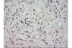 Immunohistochemical staining of paraffin-embedded Carcinoma of kidney tissue using anti-NTRK3mouse monoclonal antibody. (NTRK3 anticorps)