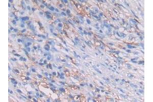DAB staining on IHC-P; Samples: Human Lung cancer Tissue (HLA-DRB1 anticorps  (AA 30-266))