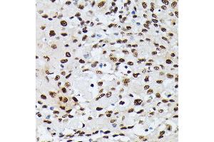 Immunohistochemistry of paraffin-embedded human esophageal cancer using hnRNPM antibody (ABIN6128031, ABIN6141919, ABIN6141920 and ABIN6222681) at dilution of 1:100 (40x lens).