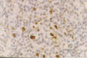 Staining of CD55 on formalin fixed paraffin embedded lymphnode (heat treated with citrate buffer retrieval) using SM1141Pdiluted1/100 (CD55 anticorps)
