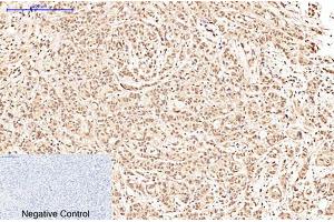 Immunohistochemical analysis of paraffin-embedded human breast cancer tissue. (POU2F1 anticorps)