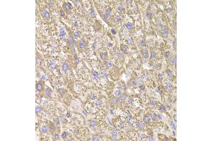 Immunohistochemistry of paraffin-embedded human liver injury using CIAPIN1 Antibody (ABIN5973750) at dilution of 1/100 (40x lens). (CIAPIN1 anticorps)