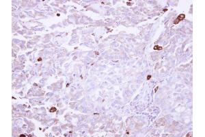 IHC-P Image Immunohistochemical analysis of paraffin-embedded human lung adenocarcinoma Macrophage, using VAP1, antibody at 1:250 dilution. (AOC3 anticorps)