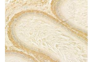 ABIN6259995 and ABIN6279131 at 1/100 staining human testicular cancer by IHC-P. (APOL3 anticorps  (N-Term))