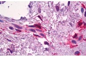 Anti-F13A1 / Factor XIIIa antibody IHC staining of human skin, dermal inflammatory cells.