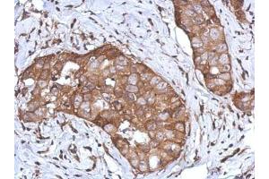 IHC-P Image Immunohistochemical analysis of paraffin-embedded human breast cancer, using CD97, antibody at 1:500 dilution.