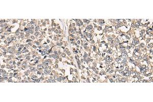 Immunohistochemistry of paraffin-embedded Human esophagus cancer tissue using C12orf40 Polyclonal Antibody at dilution of 1:50(x200) (C12orf40 anticorps)