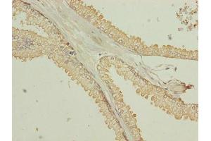 Immunohistochemistry of paraffin-embedded human prostate cancer using ABIN7173055 at dilution of 1:100 (TMEM140 anticorps  (AA 33-77))