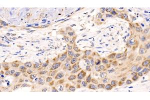 Detection of MCL1 in Human Lung cancer Tissue using Polyclonal Antibody to Induced Myeloid Leukemia Cell Differentiation Protein Mcl-1 (MCL1) (MCL-1 anticorps  (AA 2-307))