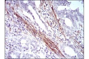 Immunohistochemical analysis of paraffin-embedded cervical cancer tissues using CNN1 mouse mAb with DAB staining. (CNN1 anticorps  (AA 16-165))