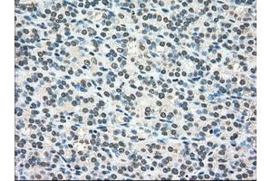 Immunohistochemical staining of paraffin-embedded Adenocarcinoma of colon tissue using anti-SCYL3mouse monoclonal antibody. (SCYL3 anticorps)