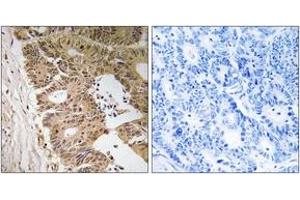 Immunohistochemistry analysis of paraffin-embedded human colon carcinoma tissue, using ZC3H8 Antibody.