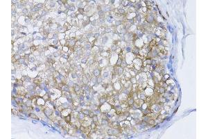 Immunohistochemistry of paraffin-embedded human breast cancer using BRCA1 antibody. (BRCA1 anticorps  (AA 120-220))